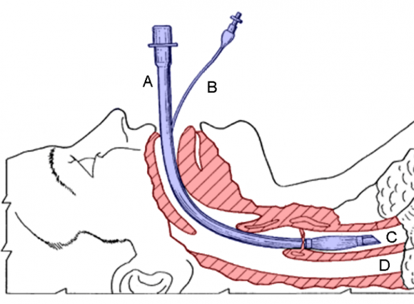 Endotracheal tube